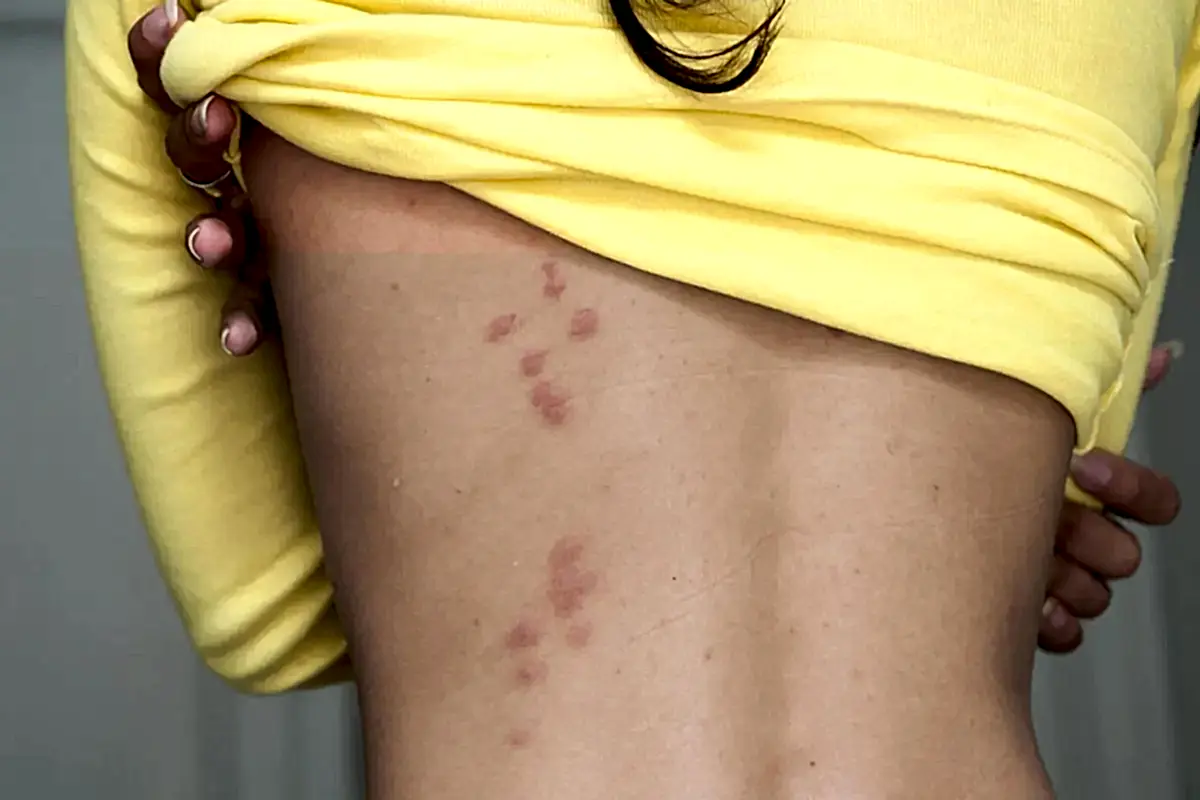 Tahta Kurusu Isırığı